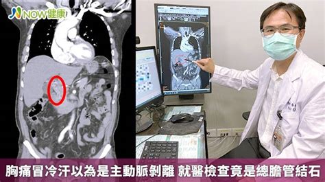 胸痛冒冷汗以為是主動脈剝離 就醫檢查竟是總膽管結石 Now健康 Line Today