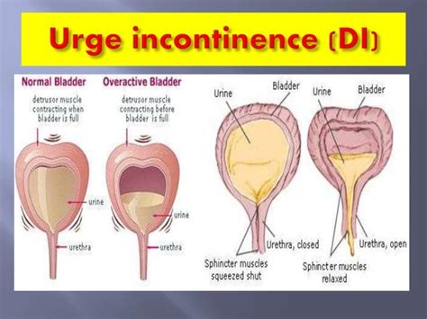 Pathophysiology Of Urinary Incontinence