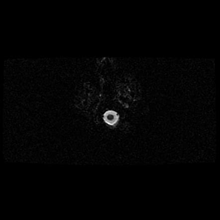 Radiation Induced Meningiomas Image Radiopaedia Org