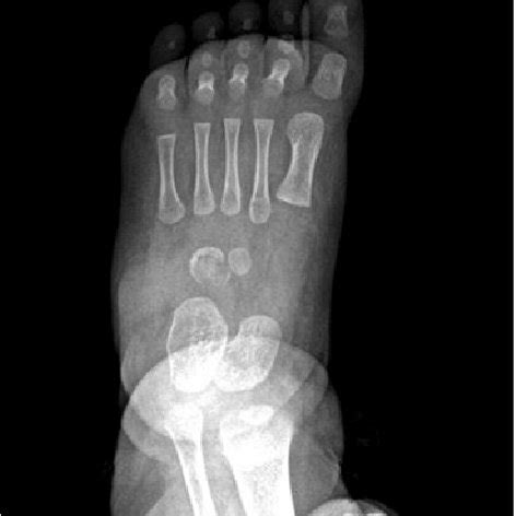 AP Radiograph Of The Foot Shows Diffuse Osteolytic Lesion And Erosions