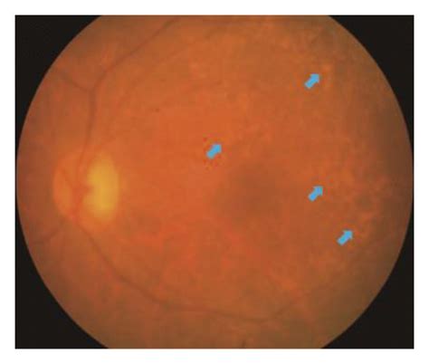 Fundus Examination Of The Left Eye Of A 67 Year Old Male Patient With Download Scientific