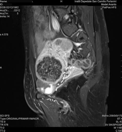 Fibroma Uterino Caso Clinico 1 Interventix