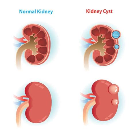 Kidney Cyst Symptoms: What You Need to Know About Kidney Cyst Signs and Symptoms - TheLifeToday