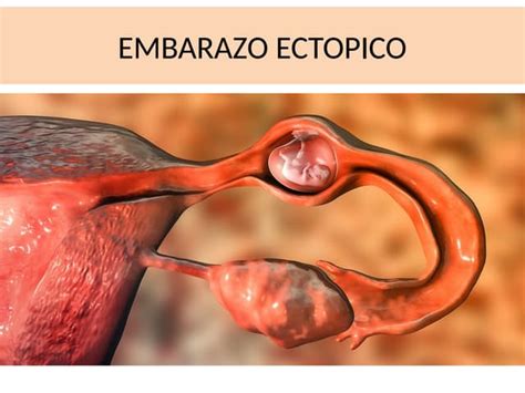 Resumen De Embarazo Ectopico Internado Rotatorio Ppt Descarga Gratuita