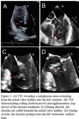 Left Ventricular Outflow Tract Obstruction Resulting From Redundant