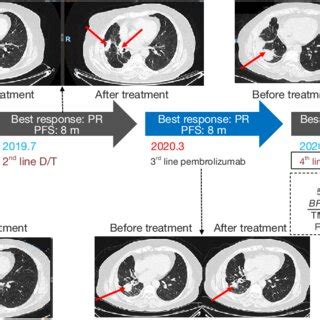 Timeline Of The Patient S Treatment History And Representative CT