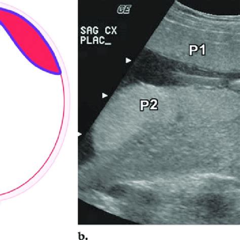 Placental Abruption A B Computed Tomographic Ct Images Show