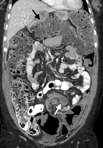 Large Bowel Obstruction In The Adult Classic Radiographic And Ct