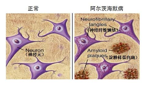 突触发现可能导向阿尔茨海默病新疗法