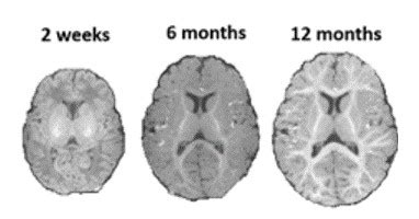 Measuring Brain Growth And Maturation Over The First Year Of Life A