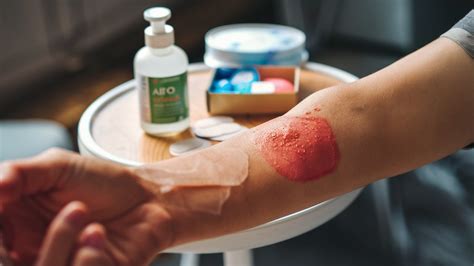 Quick Guide to Treating 1st Degree Burns at Home - Pinder Plotkin LLC