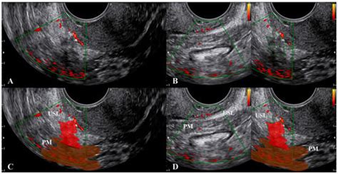 Jcm Free Full Text Ultrasound Of The Uterosacral Ligament