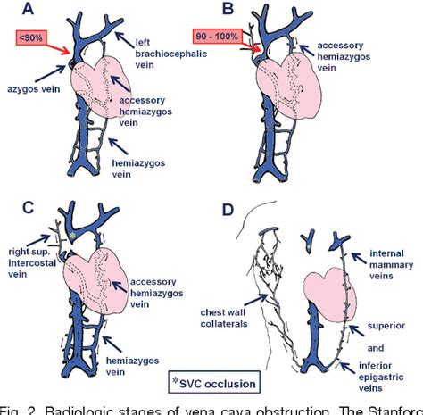 Figure From Superior Vena Cava Syndrome In Thoracic Malignancies