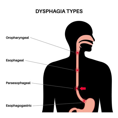 Understanding the Difference Between Odynophagia and Dysphagia | Annapolis and Severna Park, MD