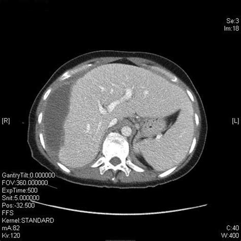 Postpartum Hellp Syndrome And Subcapsular Liver Haematoma Bmj Case Reports