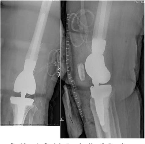 Figure From Femoral Condyle Insufficiency Fracture After Total Knee