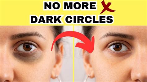 How To Remove Dark Circles Naturally In 3 Days Dark Circles Homemade