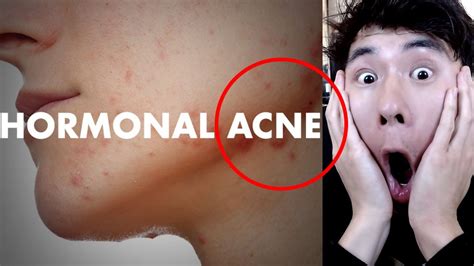 How To Heal Hormonal Acne By The Healthy Skin Coach And Biohacker Youtube