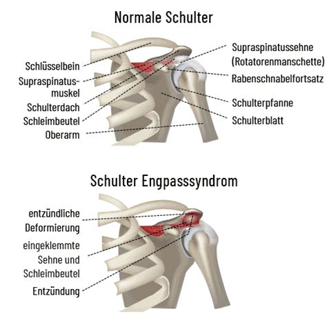 Engpasssyndrom Impingement Medikon Forchheim