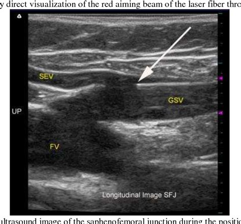 Figure From A Retrospective Study Evaluated The Safety And Clinical