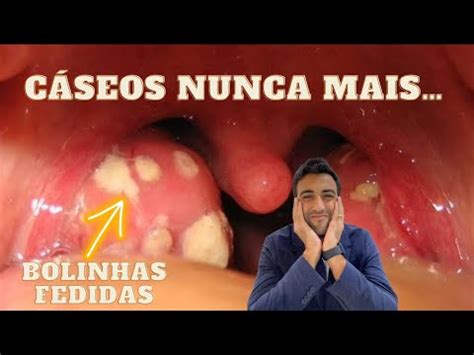 COMO ELIMINAR DEFINITIVAMENTE OS CASEOS DA AMÍGDALA SEM CIRURGIA