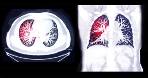 Preventing DVT & Pulmonary Embolism Prevention