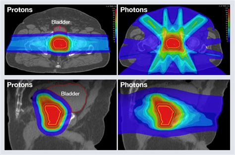 Prostate Cancer Treatment - NCI - kienitvc.ac.ke