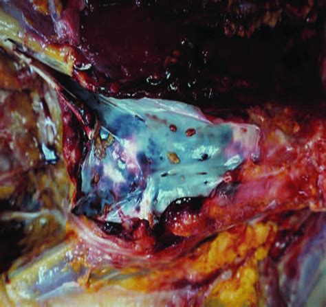 Pulmonary Trunk Artery With Multiple Fat Emboli Provided Bu The Right Download Scientific