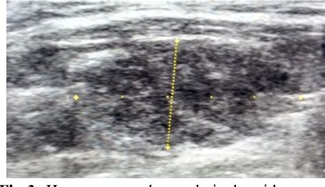 Figure 3 From Diagnosis Of Lymphocytic Thyroiditis Based On Grey Scale Evaluation In Correlation