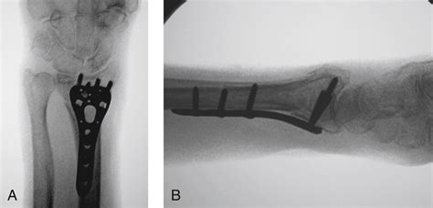 Open Reduction And Internal Fixation Of The Distal Radius With A Volar Locking Plate