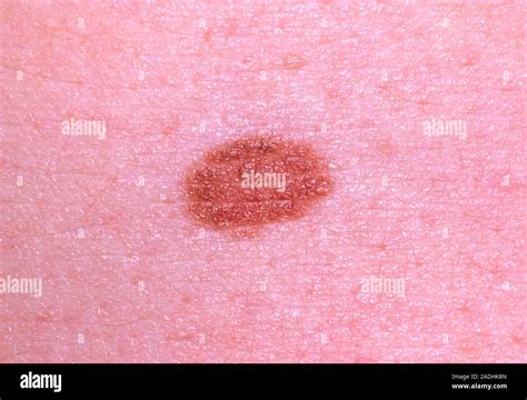 Mole Close Up Of A Benign Melanocytic Naevus Or Mole On Human Skin