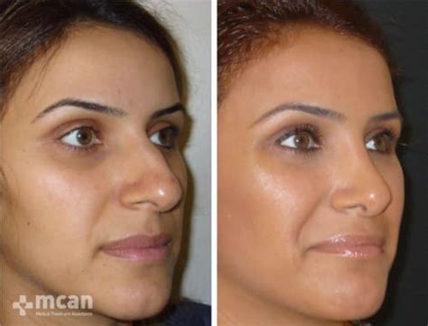 Rhinoplasty Turkey All Inclusive Nose Job In Turkey Cost 2023 2023