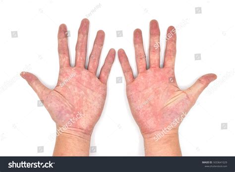 23 Palmar Erythema Images Stock Photos And Vectors Shutterstock