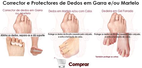 Dedos Sobrepostos Dedos Em Garra E Martelo Saiba Tudo Aqui Fingers