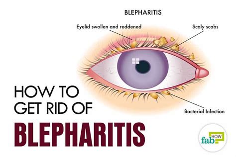 Feat How To Get Rid Of Blepharitis Blepharitis Dry Eye Remedies Eye