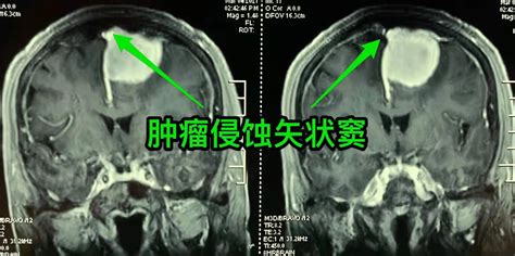 “高龄”矢状窦旁大型脑膜瘤全切术一例 脑医汇 神外资讯 神介资讯