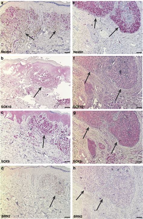 Expression Of Nestin Sox9 Sox10 And Brn2 In Melanoma Tissues In Situ