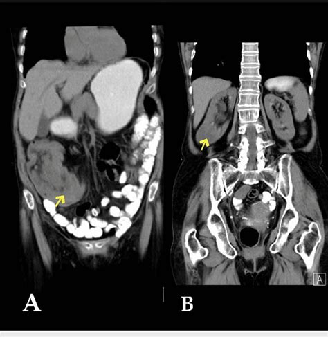 Case 2 -pre-and post-contrast CT scan of the abdomen. | Download ...