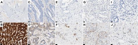 Combined Analysis Of Albumin In Situ Hybridisation And C Reactive