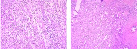 Pyogenic Granuloma Lobular Pattern Of Vascular Proliferation With