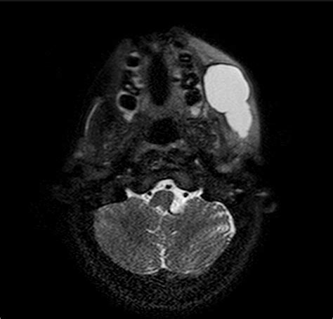videoendoscopic rehabilitation  iatrogenous stensen duct acquired