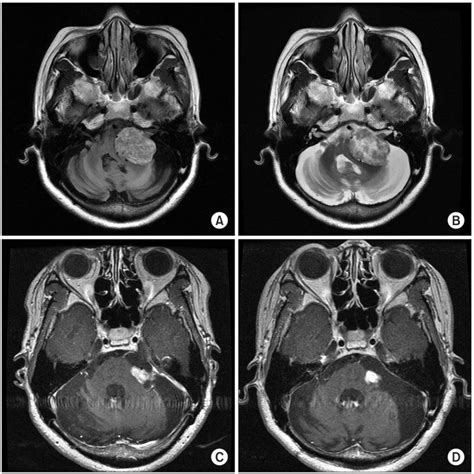 Schwannoma Mri