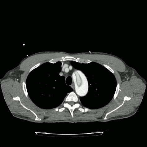 Radiology Basics Chest Pathology