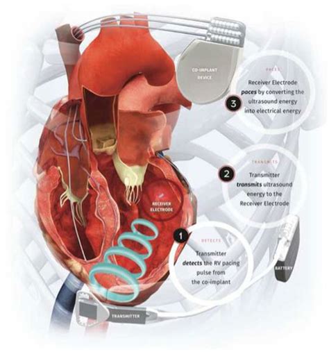 Frontiers Pacing Interventions In Non Responders To Cardiac