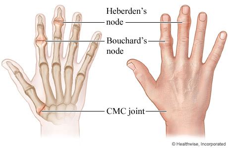 Heberden's and Bouchard's Nodes Video & Image