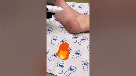 Swift Treatment For Plantar Warts Youtube