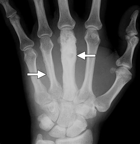 Hand Infections Anatomy Types And Spread Of Infection Imaging