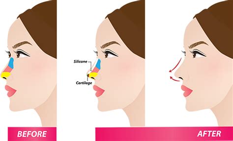 Nasal bridge augmentation – i-Aesthetic