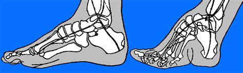 The Effects of Foot-binding on the Foot Bones (Illustration) - World ...