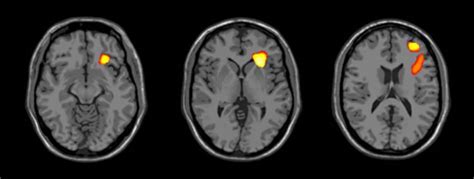 Differences In Brain Development For Adolescents With Bipolar Disorder